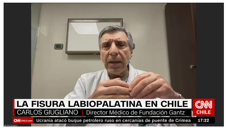 Dr. Carlos Giugliano, Director Médico de la Fundación Gantz, conversó con CNN Chile sobre la fisura labiopalatina