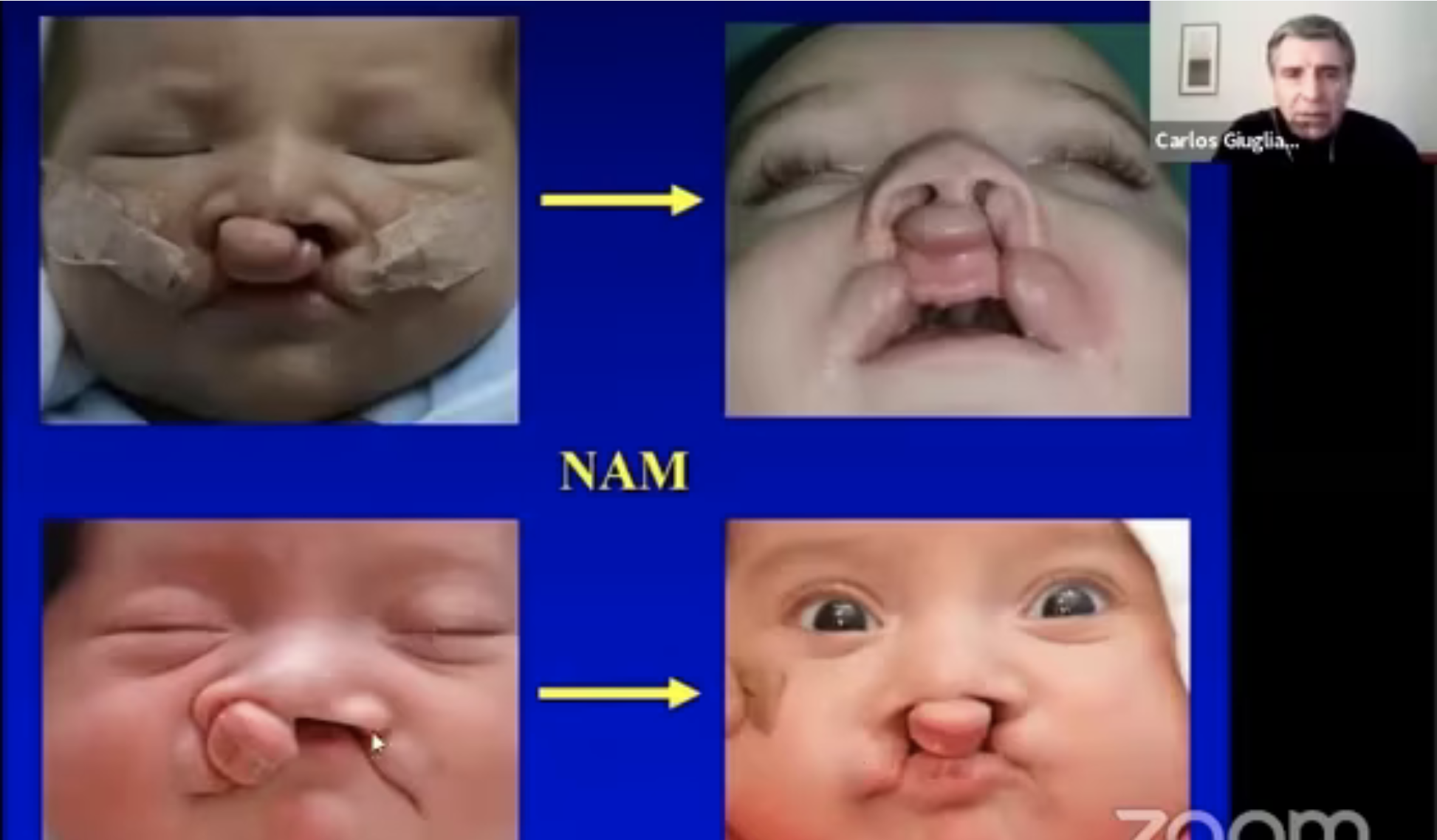 Protocolo para Rinoplastia en pacientes fisurados